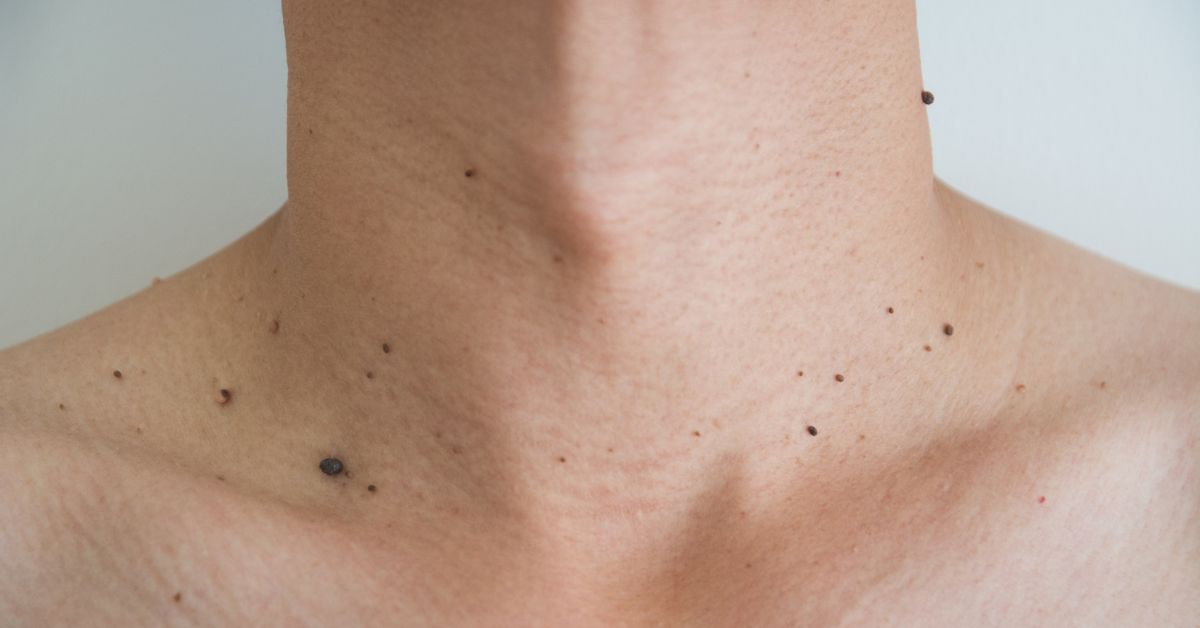 Say Goodbye to Skin Tags