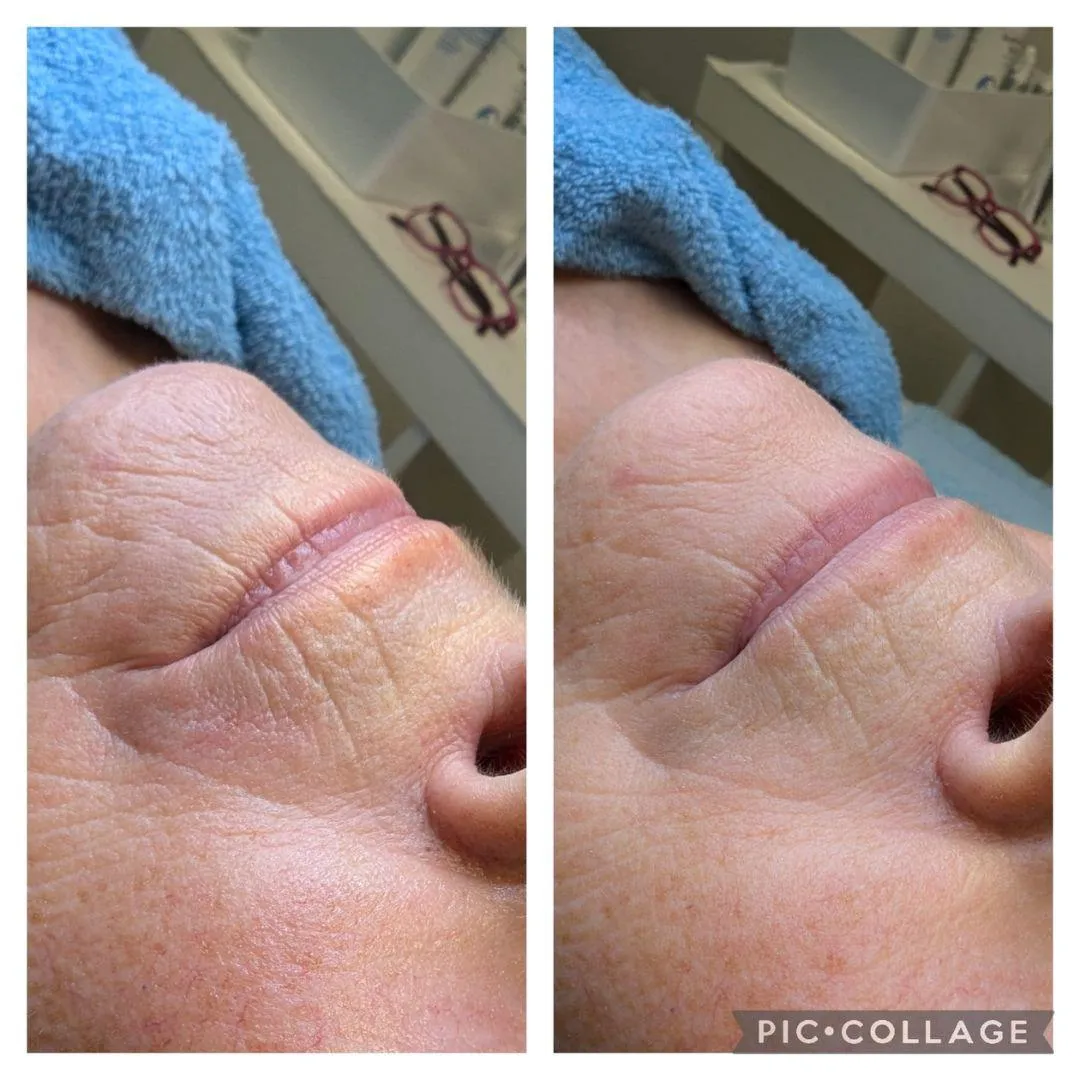 Ergebnis Anti-Aging Behandlung Kosmetikstudio Braunschweig