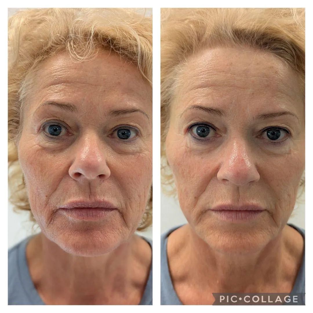 Anti-Aging Behandlung_vorher_nachher