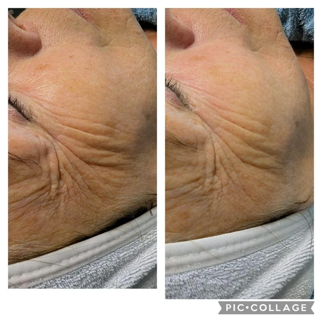 Ergebnis Anti-Aging Behandlung Braunschweig