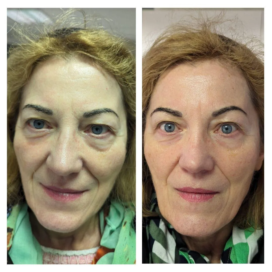 Anti-Aging Behandlung Ergebnis Kosmetikstudio Feel Well Braunschweig