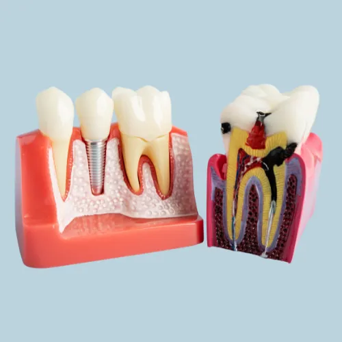 5 Signs You May Need a Dental Implant