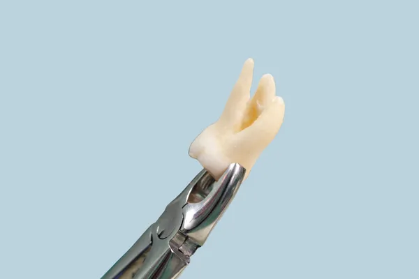 What to Expect After Wisdom Teeth Removal