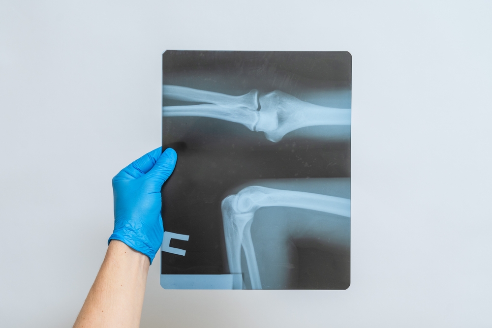 Car Accident Injuries That Don’t Show Up on X-Rays