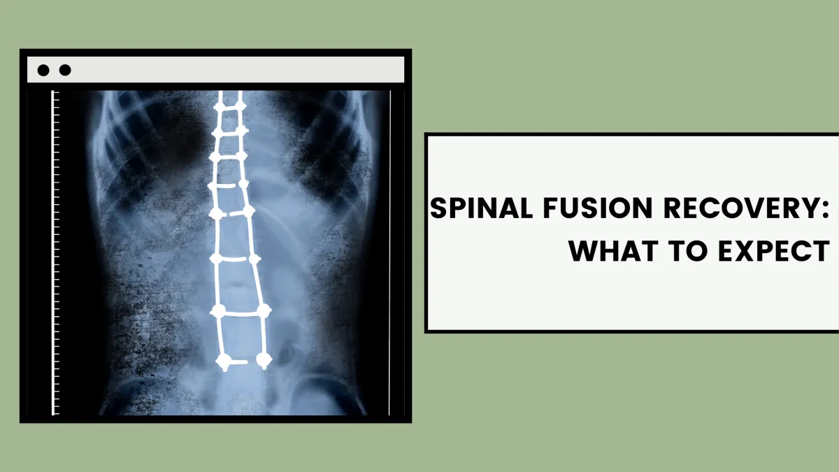 Spinal Fusion Recovery: What to Expect
