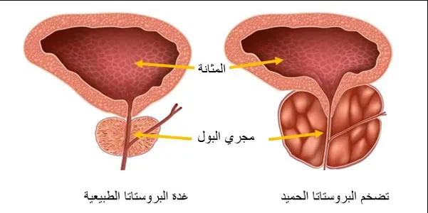 أعراض و علامات سرطان الموثة (البروستات)