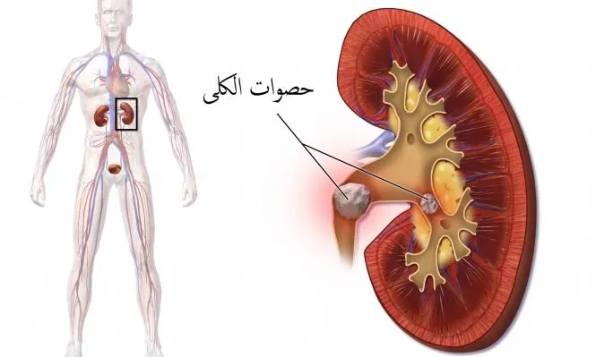 حصيات الكلى المتكررة... شرب السوائل على مدار اليوم يمنع انتكاسة المرض الأليم !
