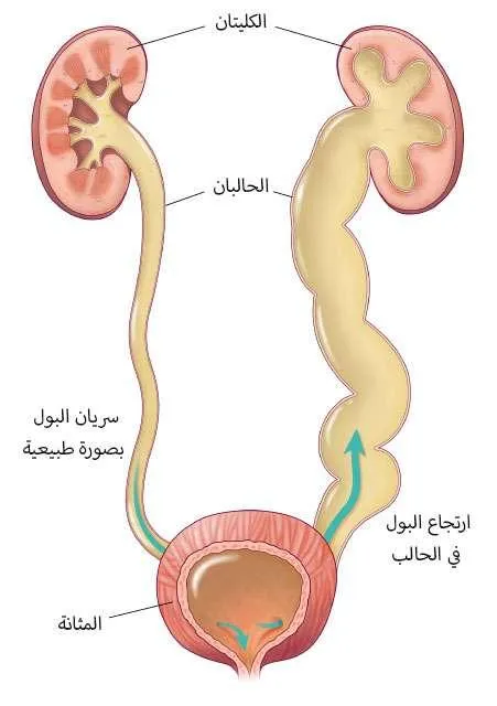 أسباب و أعراض ارتجاع البول عند الصغار