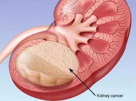 علاجات حديثة لسرطان الكلى - الدكتور صالح بن صالح