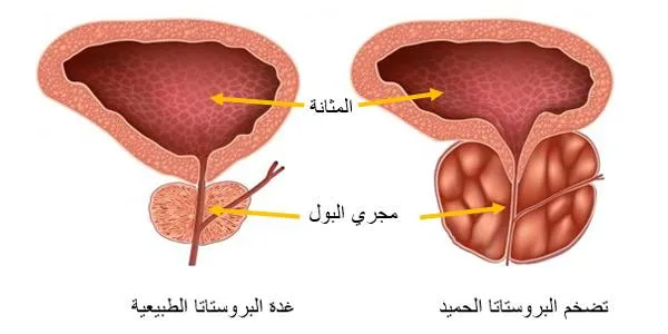 البروستات الحميد - الدكتور صالح بن صالح