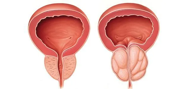 TURP أو Rezūm: مقارنة بين تقنيات علاج تضخم البروستاتا