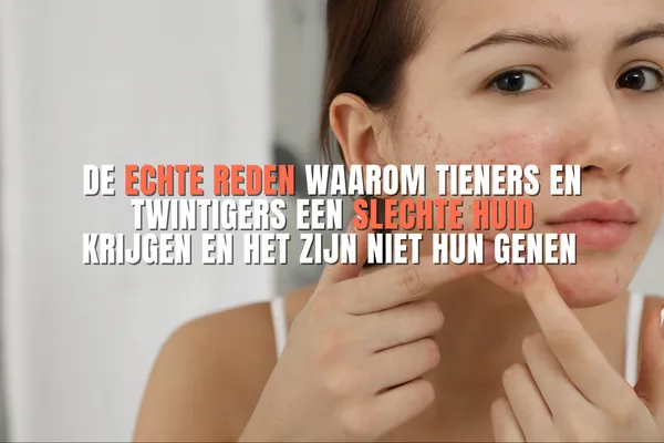 De echte reden waarom tieners en twintigers een slechte huid krijgen en het zijn niet hun genen
