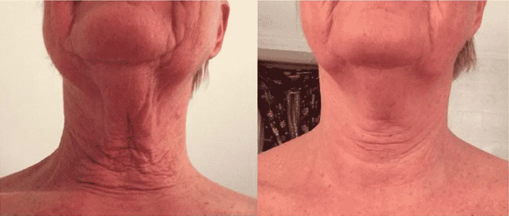 Neck wrinkles