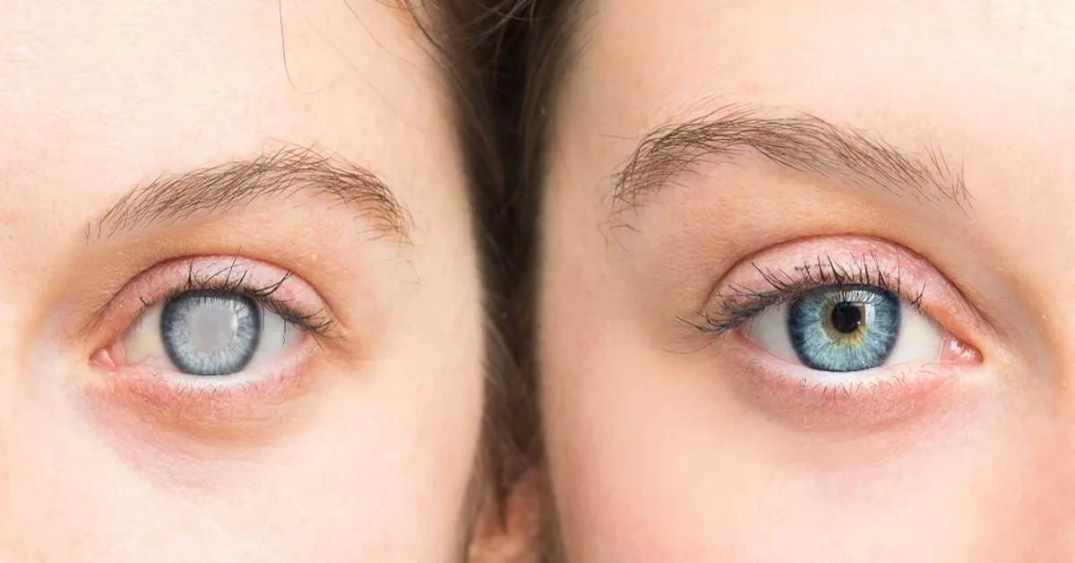Cornea Surgery and Recovery: What to Expect Before, During, and After