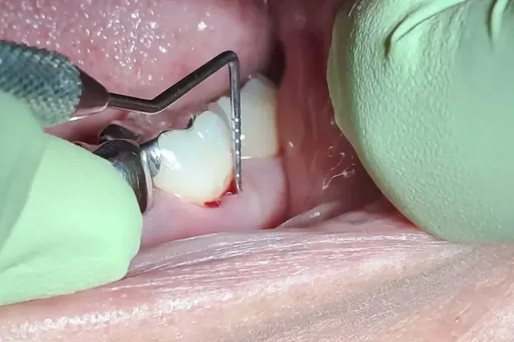 Terapia Periodontal: Eficacia del Ozono (O3) como Coadyuvante al SRP