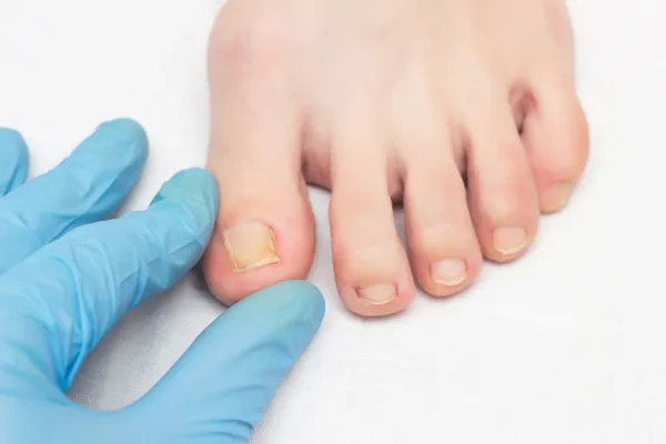 5 Myths About Ingrown Toenail Treatment – Busted!