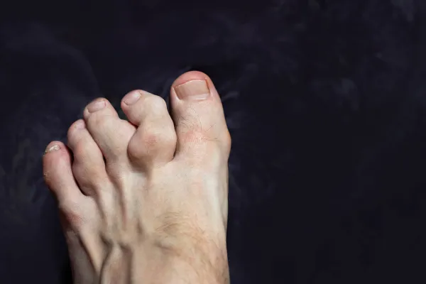 That Odd-Shaped Toe Might Be a Bigger Problem Than You Think