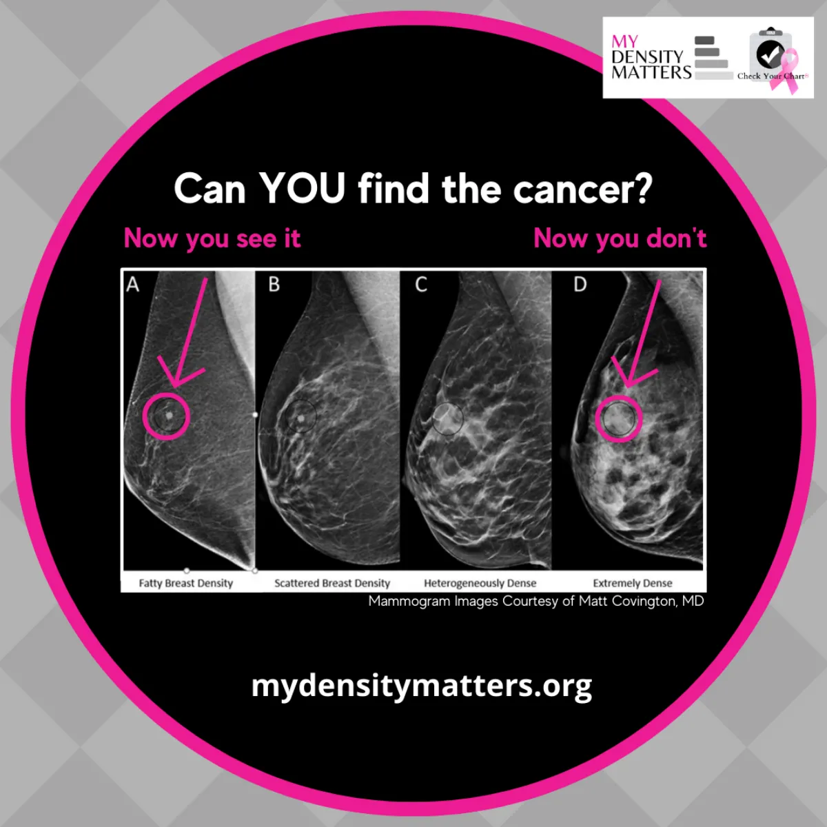 Image: Illustrating the 4 stages of breast density