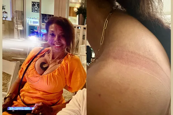 Breast Reduction Journey