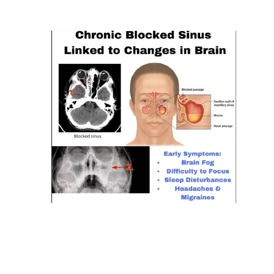blocked sinus