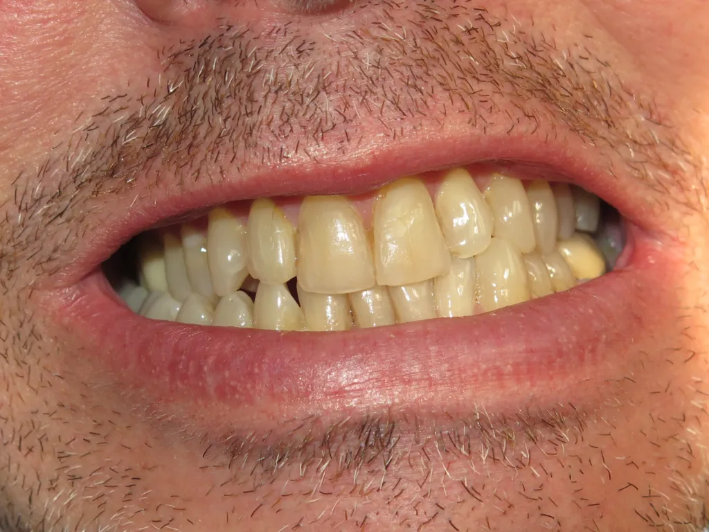 causes of toungue tie