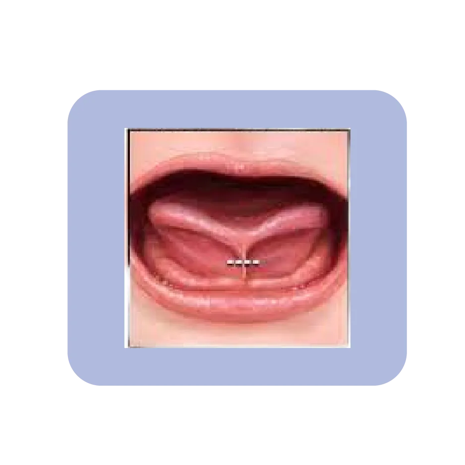 infant tongue tie release