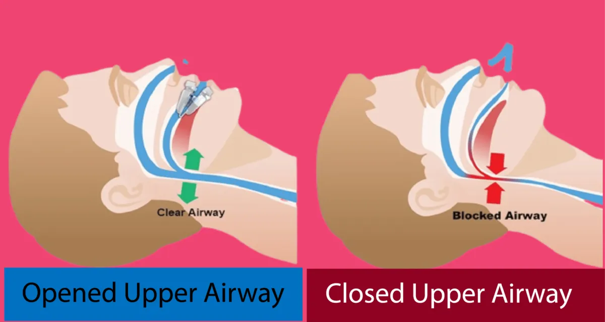 Adverse affects of snoring on health