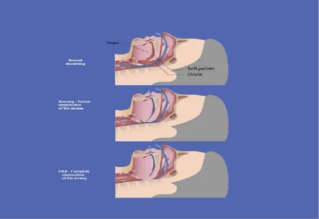 What is the Snoring Complex and why should you care