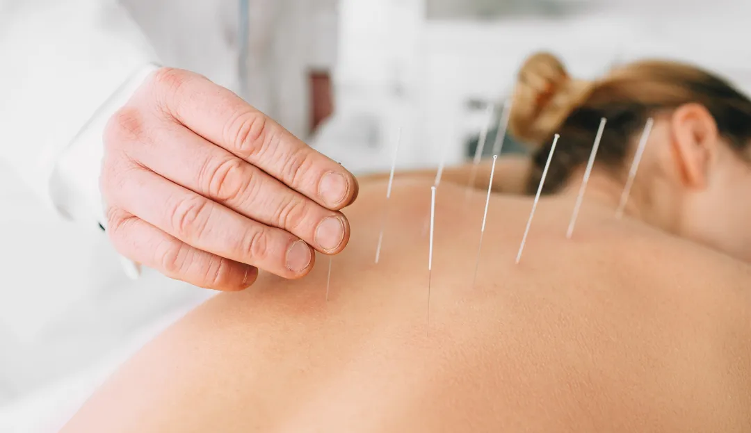 How Does Acupuncture Work and Who Can Benefit?