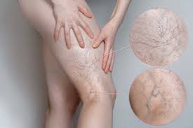 Angiología y Cirugía Vascular: ¿Qué hace este especialista y cuándo acudir?