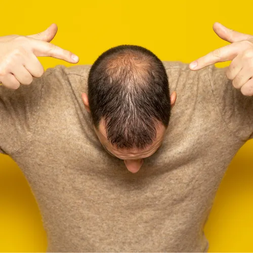 man with alopecia