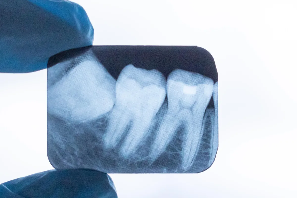 A professional and detailed image showing a gloved dentist or surgeon holding an X-ray film of a lower impacted wisdom tooth. The X-ray provides a clear view of the tooth's position in the jaw, highlighting the complexities involved in dental surgery for wisdom tooth extraction. The focus on the gloved hand and the X-ray film emphasizes the precision and care taken in dental diagnostics and treatment planning.