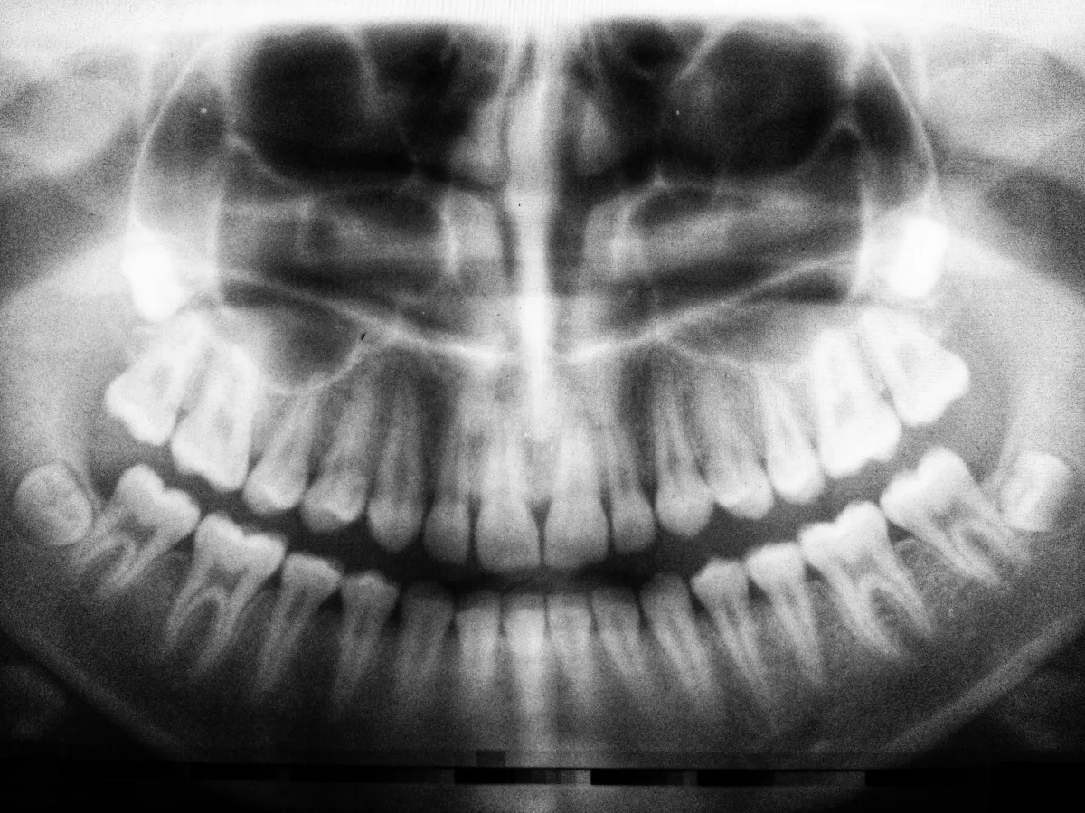 dental x ray, wisdom teeth