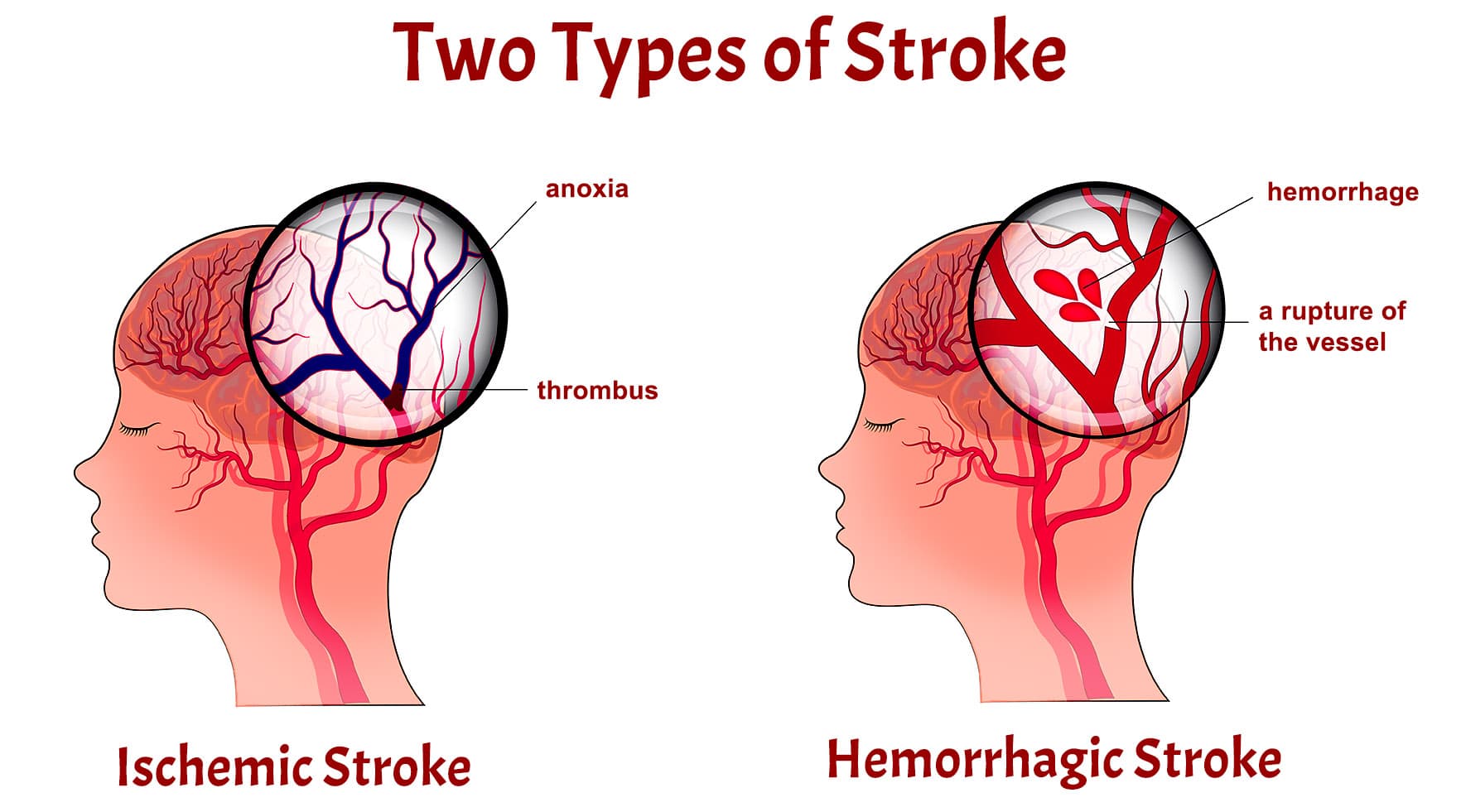 Environmental Enrichment helps recover from Stroke by accelerating the creation of new blood vessels around the infarct