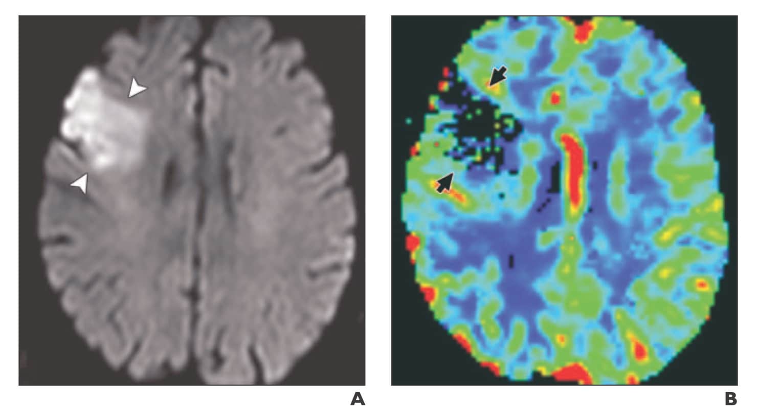 Environmental Enrichment prevents stroke-related brain damage by reducing ferroptosis