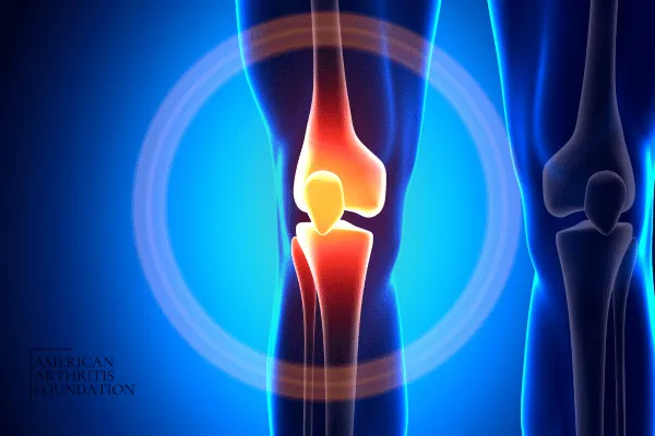 SimplifiedJoint Health Grading System