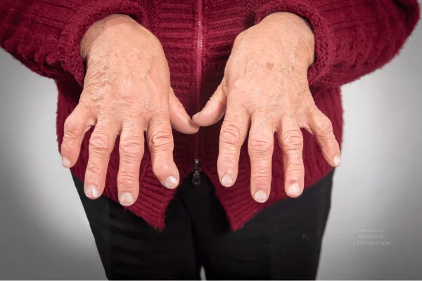 Rheumatoid Arthritis Linked to Increased Risk of Major Osteoporotic Fractures