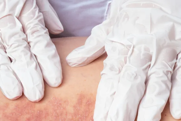 Who Should Handle Musculoskeletal Symptoms in Psoriasis Patients: Dermatologists or Rheumatologists?