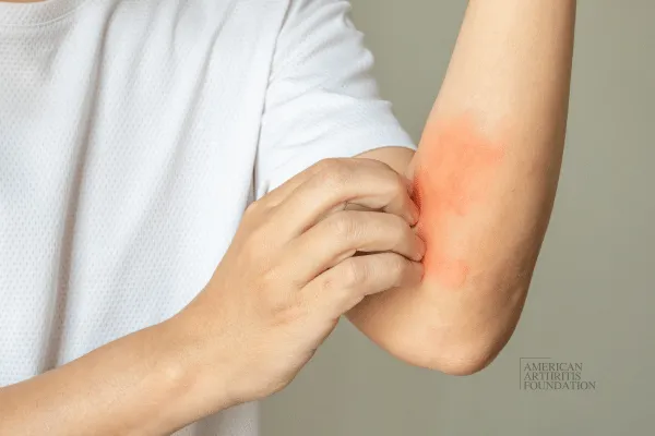 The Surprising Connection Between Psoriasis and Joint Pain: What You Need to Know