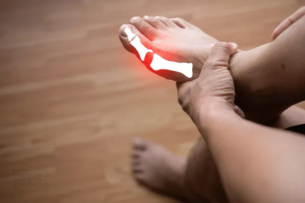 The Silent Struggle of Gout: Why Many Flares Go Unreported