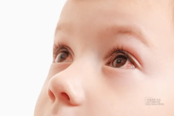 Unlocking the Genetic Link Between Juvenile Idiopathic Arthritis and Eye Inflammation