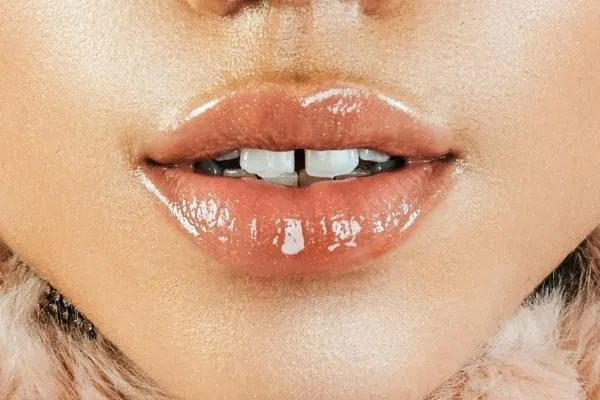 all about lip filler