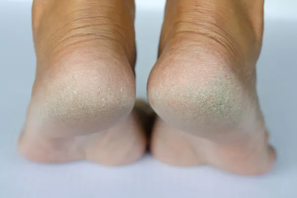 Thick, Hard Skin on Your Feet? Here's How Chiropody Can Help