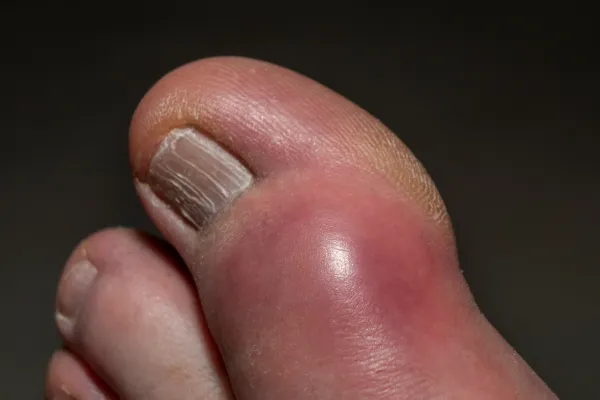 Is It Gout or Something Else? Understanding Sudden Foot Pain