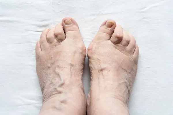 When Toes Overlap or Cross: What’s Going On and What Can Help