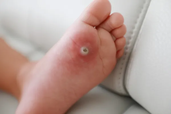 Warts vs. Corns: How to Tell the Difference (and Why It Matters)