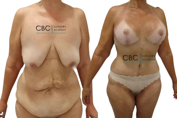 Resultado de cirugía estética tras pérdida masiva de peso: mastopexia, abdominoplastia y liposucción en CBC.