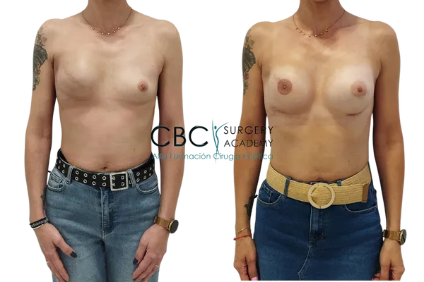 Reconstrucción mamaria tras mastectomía con implantes ergonómicos realizada en CBC.