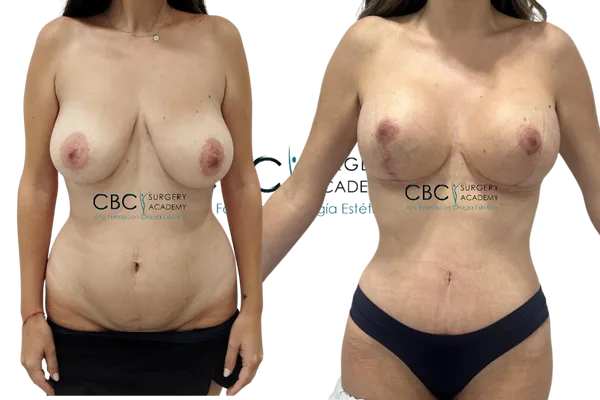 Resultado de Mommy Makeover con abdominoplastia y mastopexia tras manejo de cicatriz abdominal en CBC Surgery Institute.