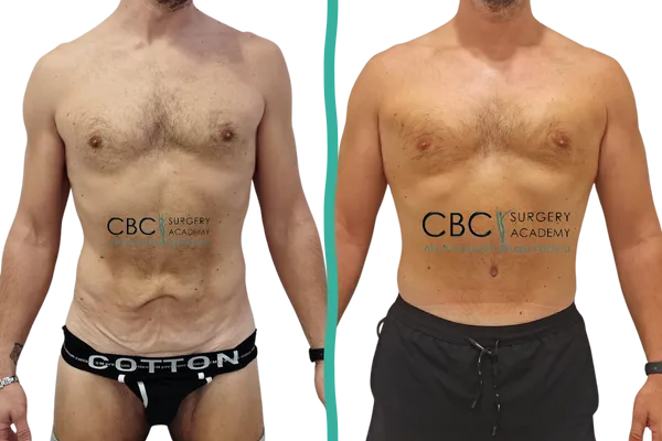 Resultado de abdominoplastia tras pérdida masiva de peso — caso clínico real del equipo CBC Surgery, con abdomen firme y cicatriz baja estética